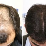 tratamiento alopecia CDI satelite